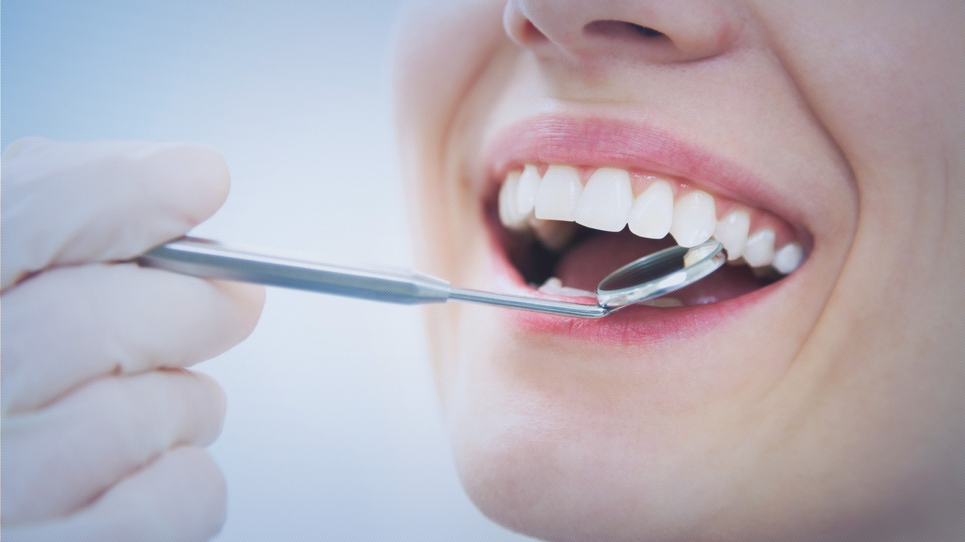 Implantes Dentários